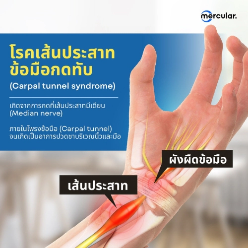 โรคเส้นประสาทข้อมือกดทับคืออะไร